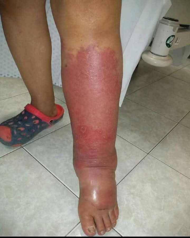 🇺🇲My Personal Routine for Relieving Leg and Ankle Swelling